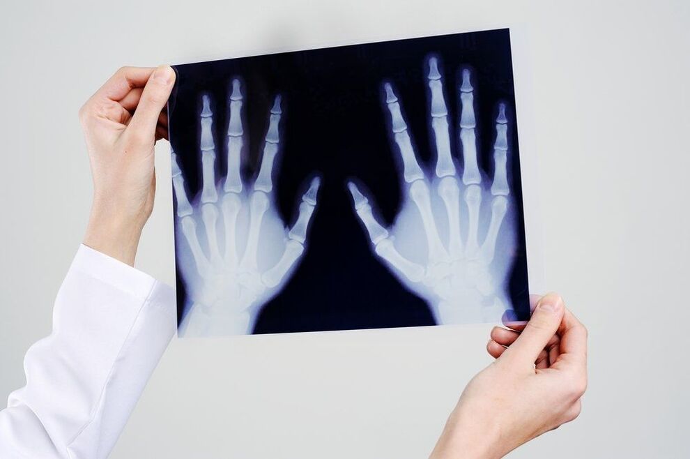 diagnóstico de las articulaciones de la mano