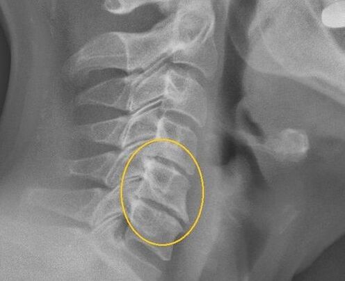 Osteocondrosis de la columna cervical en una raya x