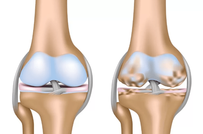 Deformando la artrosis de la articulación de la rodilla