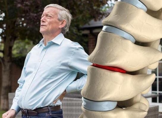 La osteocondrosis afecta los discos intervertebrales y provoca dolor de espalda.